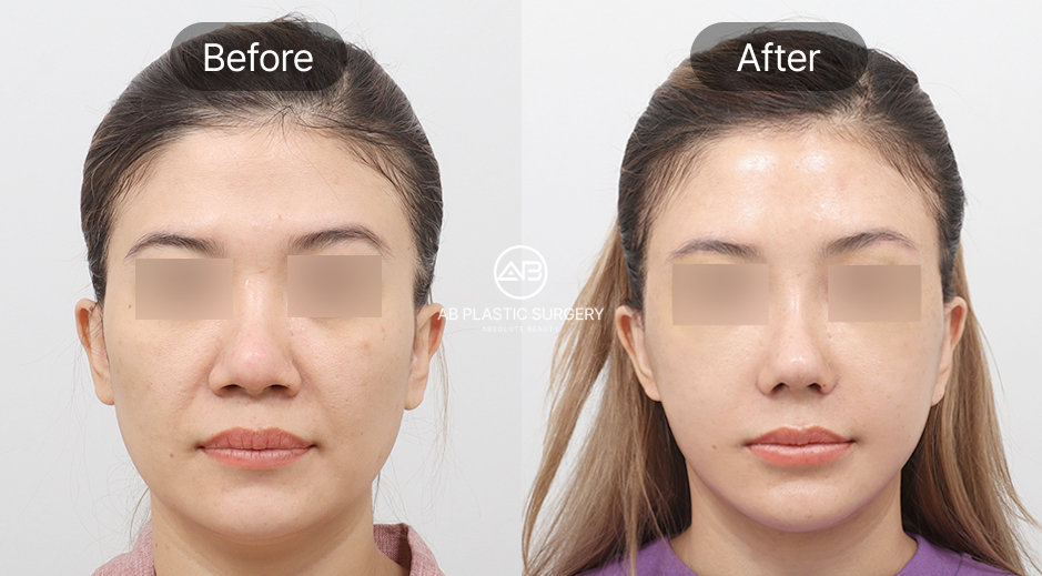 ภาพก่อน–หลังของผู้หญิง หลังทำการดึงหน้าแบบ SMAS ที่เกาหลีโรงพยาบาลศัลยกรรมAB เห็นการเปลี่ยนแปลง ใบหน้าดูกระชับ ร่องแก้มตื้นขึ้น และผิวดูเรียบเนียนขึ้น