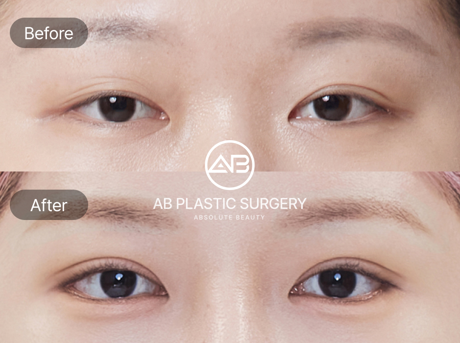 ภาพก่อนหลังศัลยกรรมแก้ตาปรือ ที่โรงพยาบาลศัลยกรรมAB เกาหลี หลังผ่าตัดดวงตาดูโต สดใสและผลลัพธ์เป็นธรรมชาติ