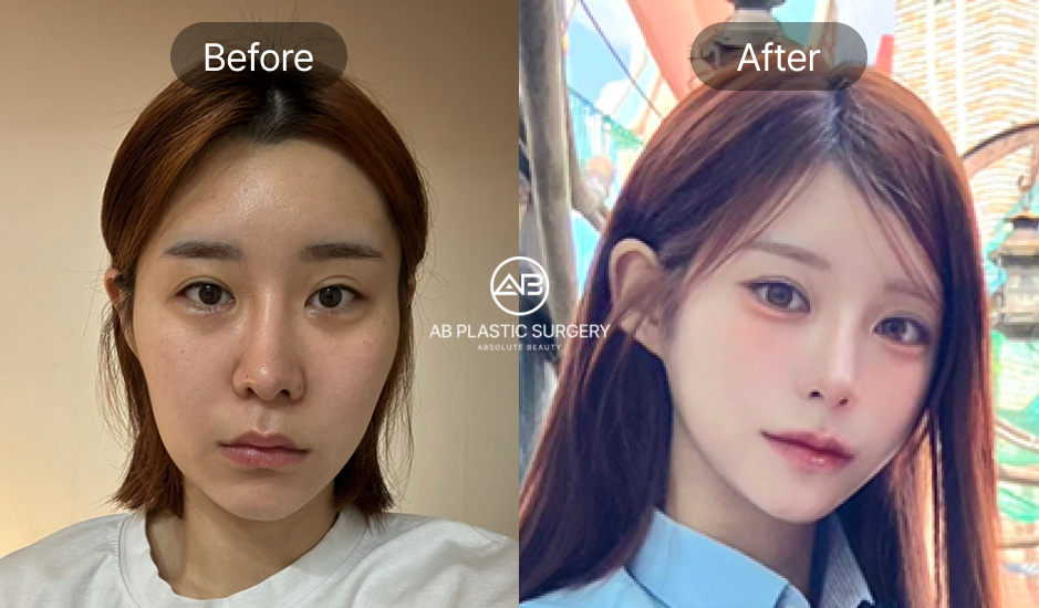 ภาพก่อน–หลังการตัดกราม ใบหน้าจากกว้างแข็งเปลี่ยนเป็นเรียวเล็กสมส่วน ผลลัพธ์ศัลยกรรมโครงหน้าที่โรงพยาบาลศัลยกรรมAB ประเทศเกาหลี