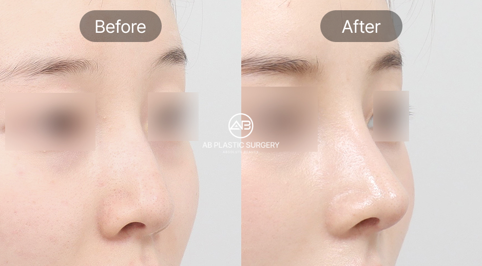 ภาพรีวิวศัลยกรรมจมูก ก่อน–หลัง เหลาฮัมพ์ที่โรงพยาบาลศัลยกรรม AB ประเทศเกาหลี ด้านซ้ายก่อนเหลาฮัมพ์จมูก เห็นฮัมพ์ชัดเจนแม้เคยเสริมซิลิโคน ด้านขวาหลังผ่าตัดจมูกเรียบเนียนและสมดุลกับใบหน้า