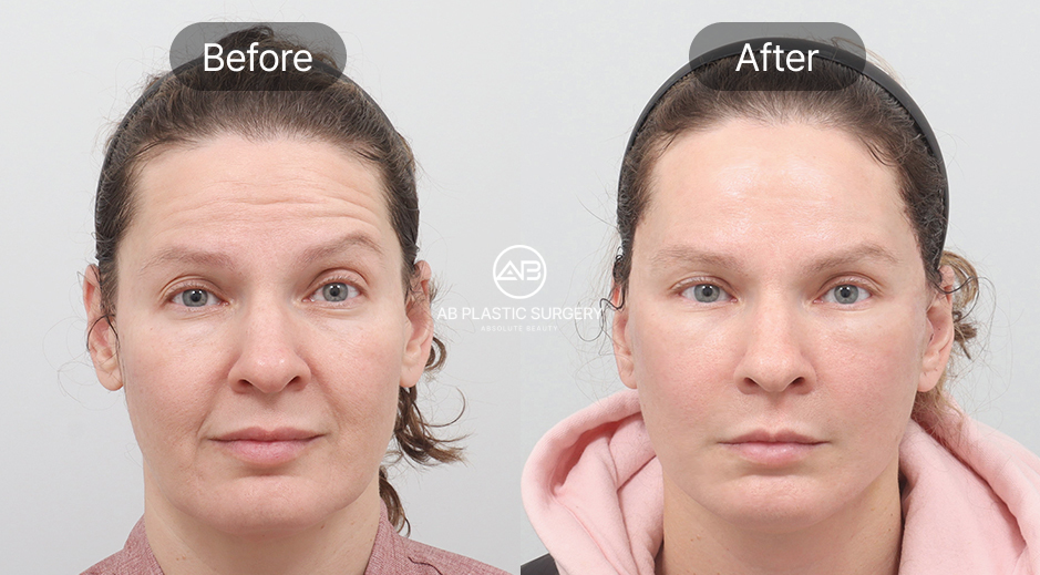 ภาพก่อน–หลังของผู้หญิง หลังทำการดึงหน้าแบบ SMAS ที่เกาหลีโรงพยาบาลศัลยกรรมAB ใบหน้าดูกระชับขึ้น ริ้วรอยลดลง และสีผิวดูสม่ำเสมอมากขึ้น