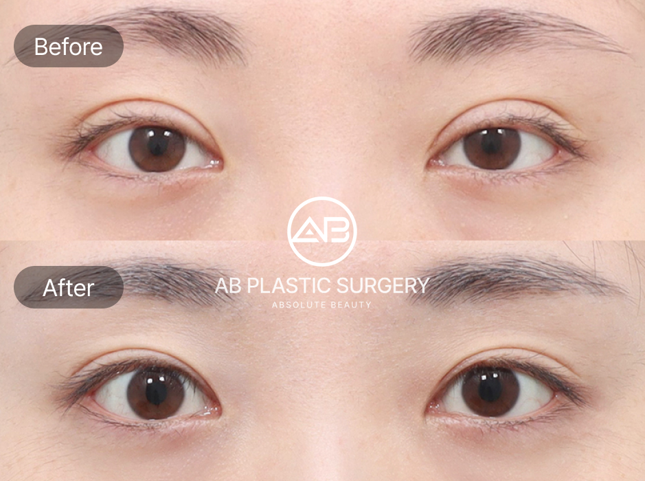 ภาพก่อนหลังศัลยกรรมแก้ตาปรือ โรงพยาบาลศัลยกรรมAB เกาหลี หลังการพักฟื้นดวงตาดูสดใส โตขึ้น และผลลัพธ์เป็นธรรมชาติ