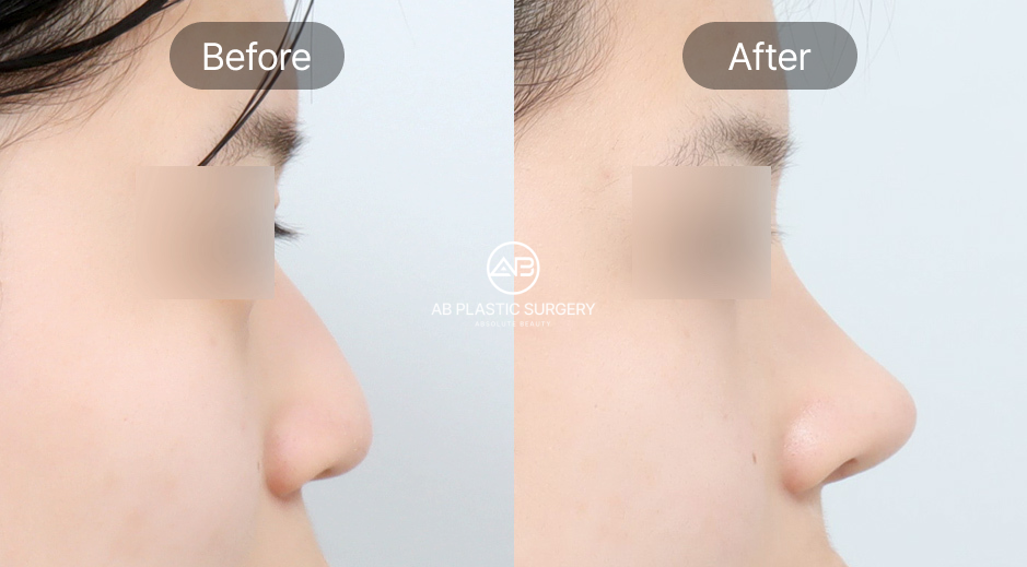 ภาพรีวิวศัลยกรรมจมูก ก่อน–หลัง เหลาฮัมพ์ที่โรงพยาบาลศัลยกรรม AB ประเทศเกาหลี ด้านซ้ายก่อนเหลาฮัมพ์จมูก ทรงโค้งคล้ายจมูกเหยี่ยว ด้านขวาหลังผ่าตัดจมูกทรงตรงและได้สัดส่วน ทำให้ภาพลักษณ์โดยรวมดูอ่อนหวานขึ้น