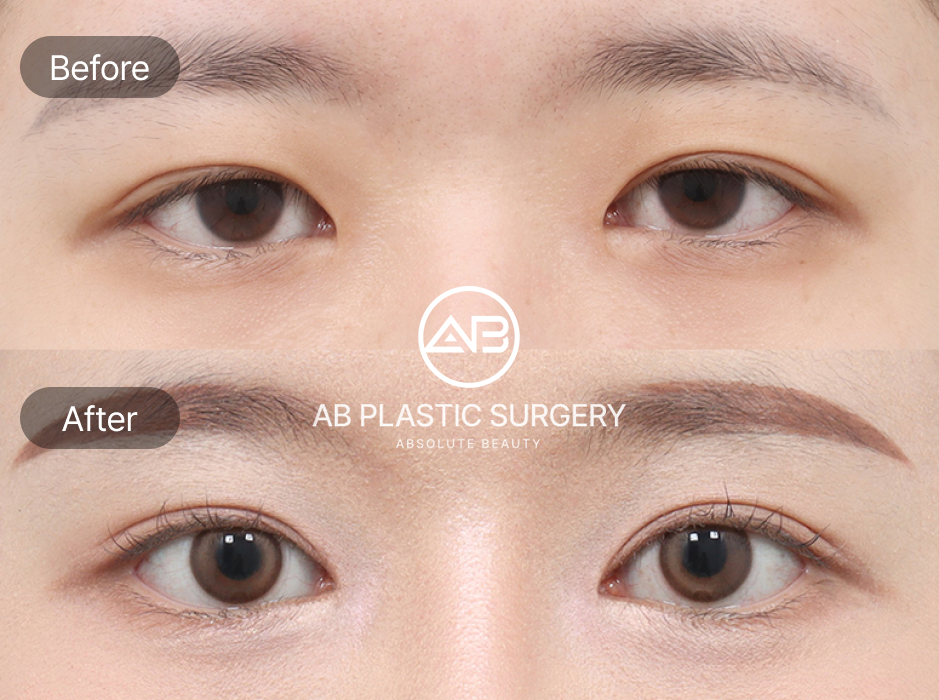 ภาพรีวิวก่อนหลังแก้ตาปรือจริงจากผู้เข้ารับบริการที่โรงพยาบาลศัลยกรรมAB เกาหลี ดวงตาหลังผ่าตัดดูโต เปิดกว้าง และเป็นธรรมชาติ