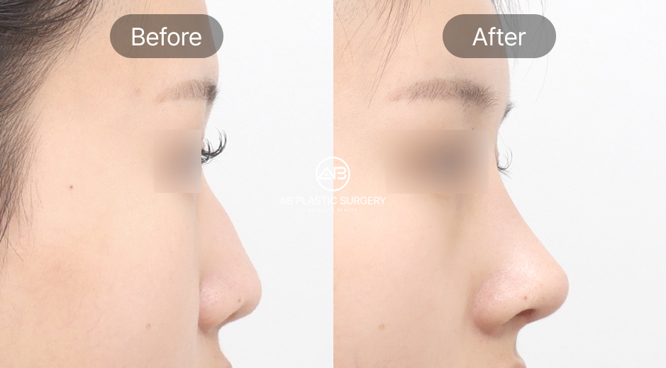 รูปก่อนและหลังการศัลยกรรมเหลาฮัมพ์