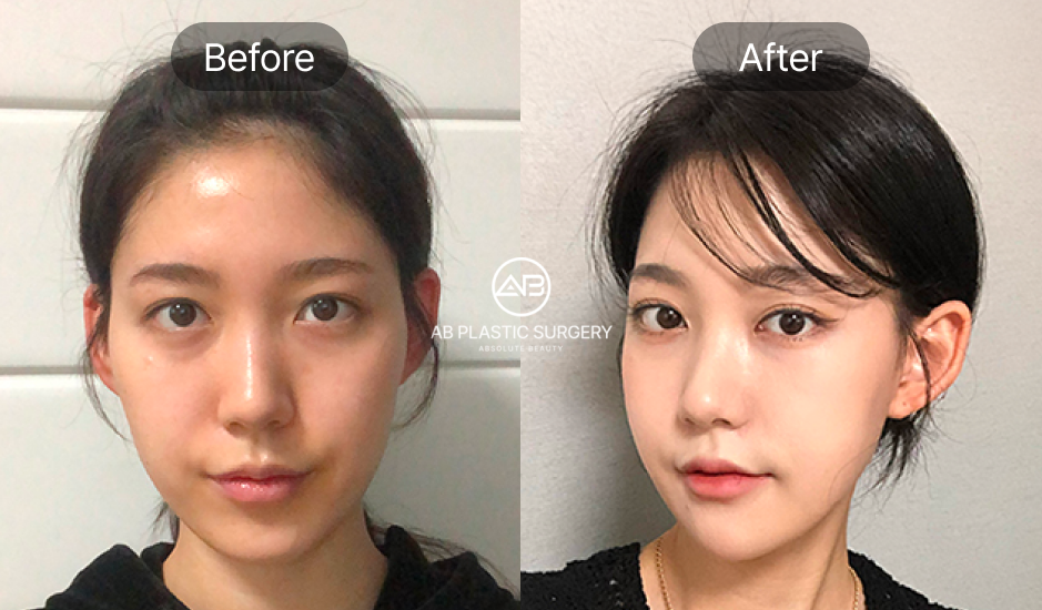 ภาพก่อน–หลังการตัดกราม ปรับโครงหน้าให้เรียวเล็กและสมส่วน  รีวิวจริงจากโรงพยาบาลศัลยกรรม AB ประเทศเกาหลี