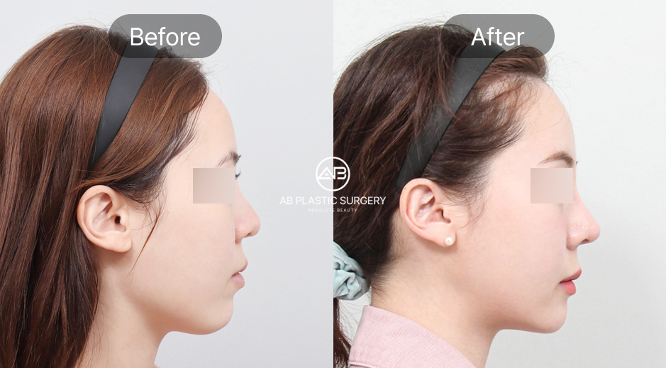 ศัลยกรรมคางถอยแบบเกาหลี ภาพก่อนหลัง (Before After) เหมาะสำหรับผู้ที่มีคางร่น กรอบหน้าไม่ชัด โรงพยาบาลศัลยกรรมAB