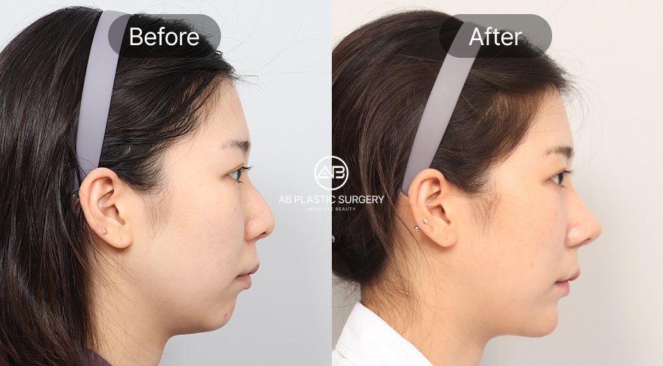 ศัลยกรรมคางถอยแบบเกาหลี ภาพก่อนหลัง (Before After) แก้ปัญหาคางร่น กรอบหน้าไม่ชัด ให้รูปหน้าสมส่วน โรงพยาบาลศัลยกรรมAB