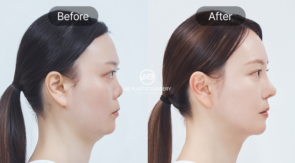 ศัลยกรรมคางถอยแบบเกาหลี ภาพก่อนหลัง (Before After) เทคนิคเลื่อนกระดูกคาง ปรับคางให้ยาวสมดุล กรอบหน้าชัดเจน โรงพยาบาลศัลยกรรมAB