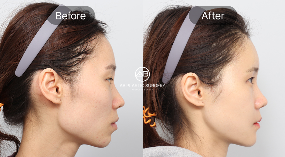 ศัลยกรรมคางถอยแบบเกาหลี ภาพก่อนหลัง (Before After) การเสริมคางด้วยซิลิโคนหรือกระดูกอ่อน ช่วยปรับคางให้ยาวและสมดุล โรงพยาบาลศัลยกรรมAB