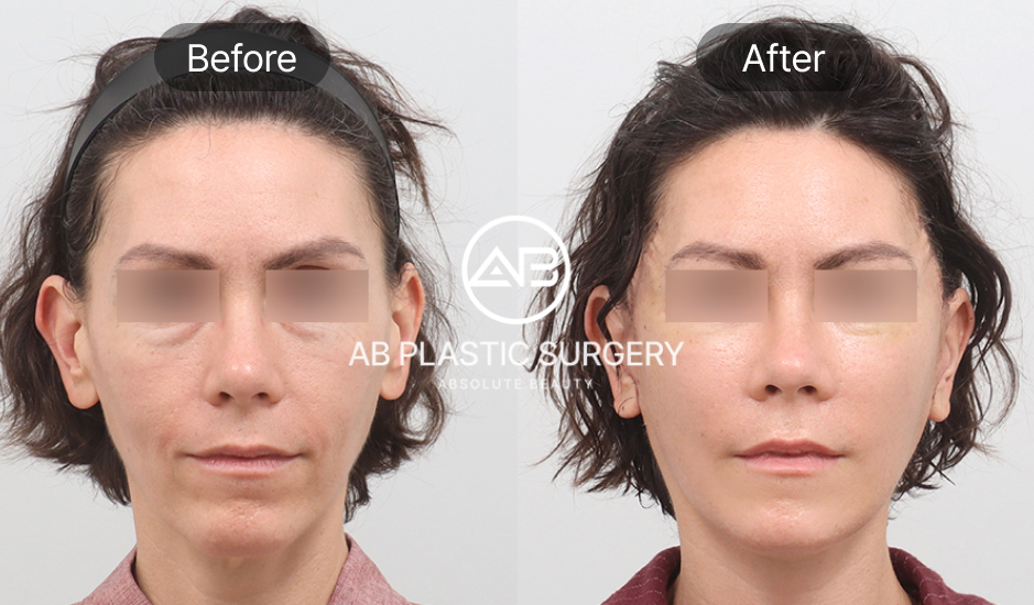 ภาพก่อนและหลังการดึงหน้าด้วยการผ่าตัด (Surgical Facelift) เปรียบเทียบกับการร้อยไหม ที่ โรงพยาบาลศัลยกรรมAB ผลลัพธ์ยกกระชับชัดเจนและอยู่ได้นาน