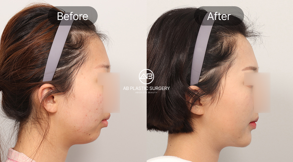 ศัลยกรรมคางถอยแบบเกาหลี ภาพก่อนหลัง (Before After) ขั้นตอนการประเมินและวางแผนก่อนการผ่าตัด โรงพยาบาลศัลยกรรมAB