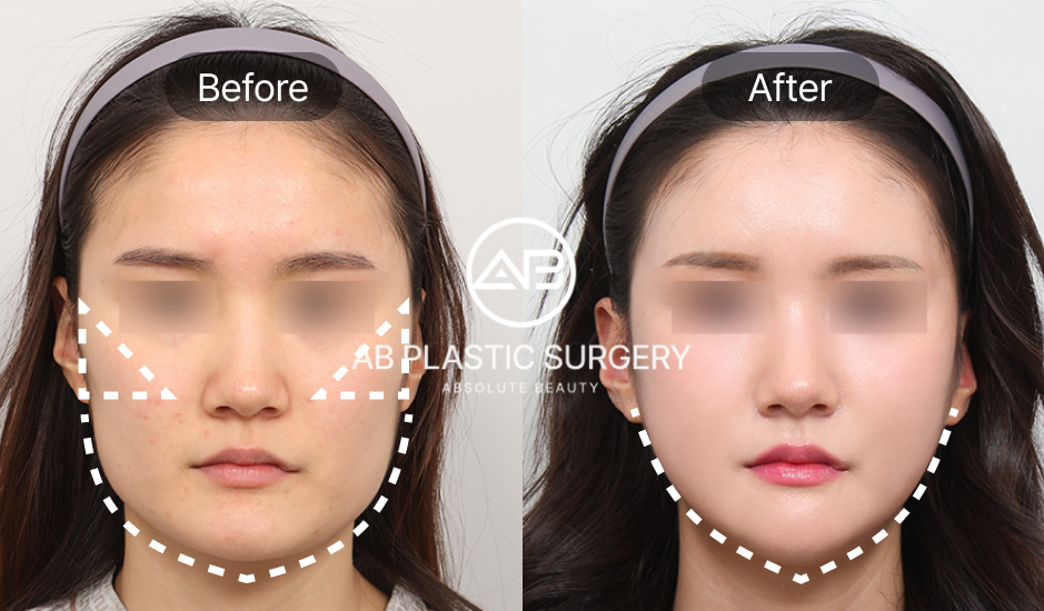 ภาพก่อนหลัง ศัลยกรรมลดโหนกแก้มสูงแบบเกาหลี ขั้นตอนการผ่าตัดและการพักฟื้น ที่เกาหลีโรงพยาบาลศัลยกรรมAB แสดงผลลัพธ์การปรับรูปหน้าให้ละมุนและสมส่วน – ศัลยกรรมโหนกแก้ม, ปรับรูปหน้า, รูปก่อนหลังศัลยกรรม