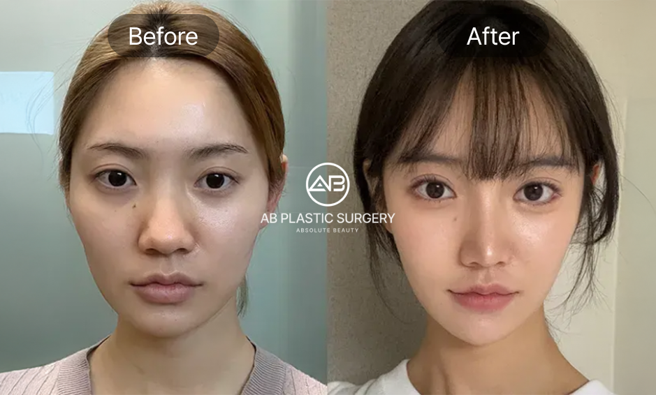 ภาพก่อนและหลัง (Before & After) ศัลยกรรมเสริมจมูก ทรงสโลปและทรงหยดน้ำ ช่วยปรับโครงหน้าเป็นรูปไข่ ดูอ่อนหวานและละมุน โรงพยาบาลศัลยกรรมAB