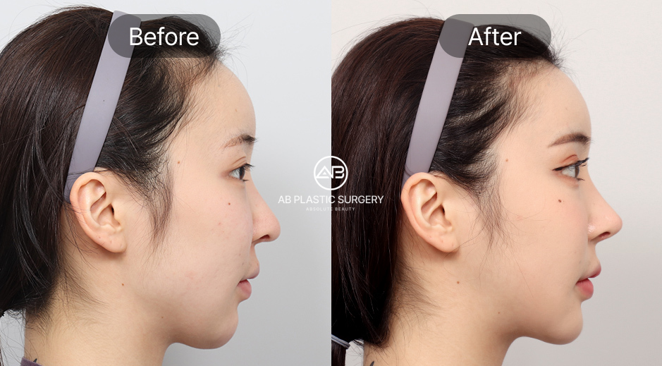 ศัลยกรรมคางถอยแบบเกาหลี ภาพก่อนหลัง (Before After) การพักฟื้นและผลลัพธ์ที่คาดหวัง โรงพยาบาลศัลยกรรมAB