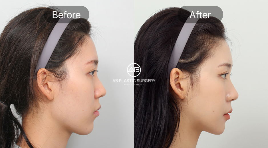 ศัลยกรรมคางถอยแบบเกาหลี ภาพก่อนหลัง (Before After) ผลลัพธ์ที่คาดหวัง กรอบหน้าคมชัดและเป็นธรรมชาติ โรงพยาบาลศัลยกรรมAB