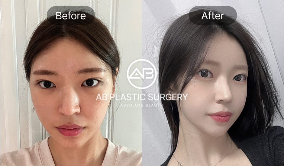 ภาพก่อนและหลัง (Before & After) ศัลยกรรมเสริมจมูก สำหรับใบหน้ารูปสี่เหลี่ยม ทรงสายเกาหลีและทรงสโลป ช่วยลดความแข็งและเพิ่มความอ่อนโยน โรงพยาบาลศัลยกรรมAB