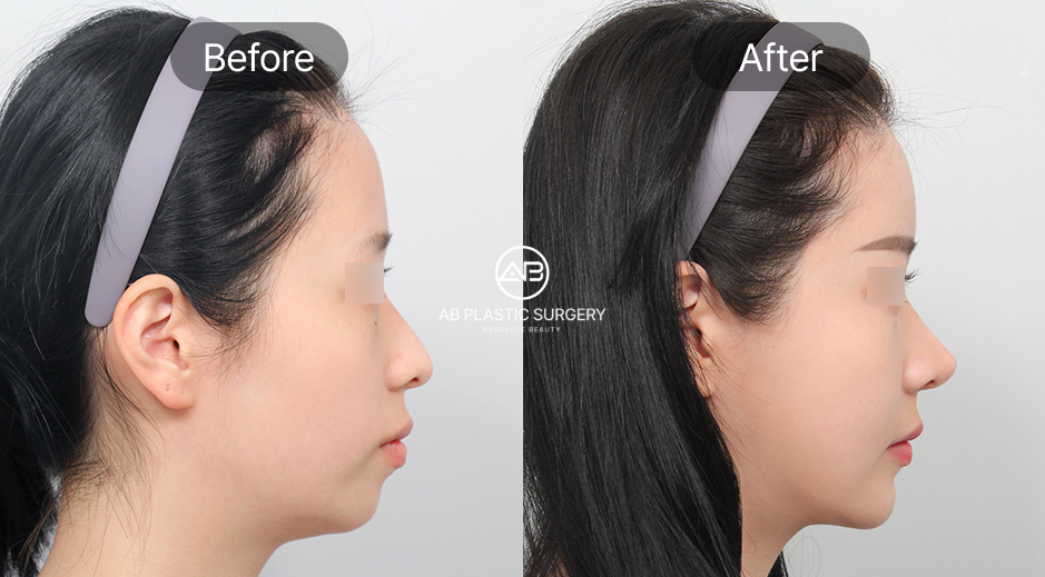 ศัลยกรรมคางถอยแบบเกาหลี ภาพก่อนหลัง (Before After) รีวิวผลลัพธ์จริงจากผู้เข้ารับบริการ โรงพยาบาลศัลยกรรมAB