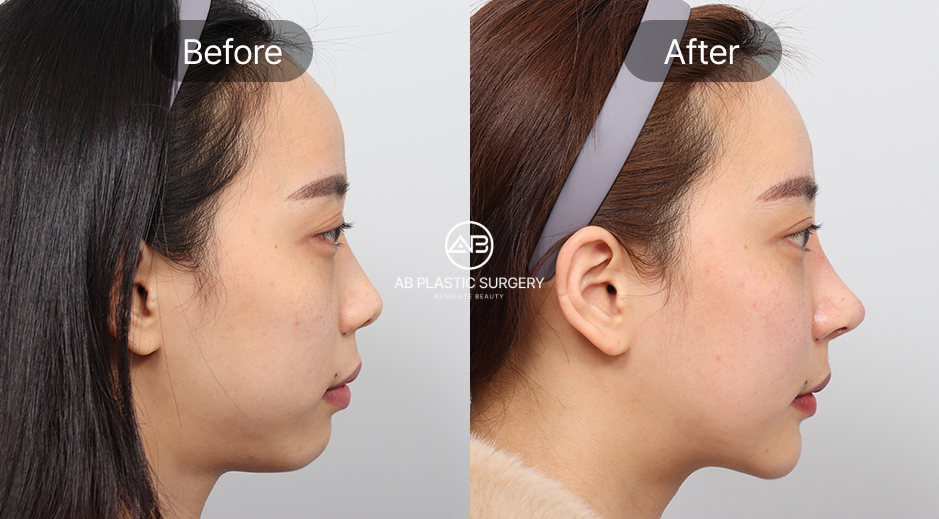 ศัลยกรรมคางถอยแบบเกาหลี ภาพก่อนหลัง (Before After) คำถามที่พบบ่อยเกี่ยวกับศัลยกรรมคางถอย โรงพยาบาลศัลยกรรมAB