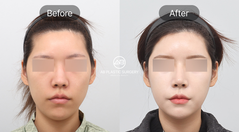 ภาพก่อนและหลังเสริมคางของผู้ที่มีคางไม่เท่ากัน ปรับแนวคางให้ตรงและสมดุลกับใบหน้าทั้งสองข้าง กรอบหน้าดูเรียวและละมุนขึ้นอย่างเป็นธรรมชาติ