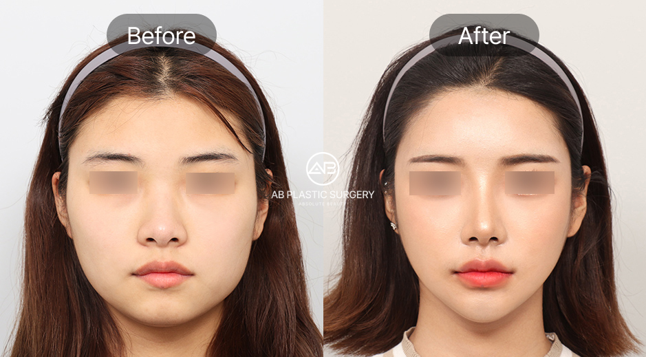 ภาพก่อนและหลังเสริมคางเกาหลีที่โรงพยาบาลศัลยกรรม AB ประเทศเกาหลี เคสคางสั้น ปรับแนวคางให้ยื่นออกมาอย่างสมดุล ใบหน้าดูเรียวยาวขึ้นและได้สัดส่วนธรรมชาติตามแบบ K-Beauty