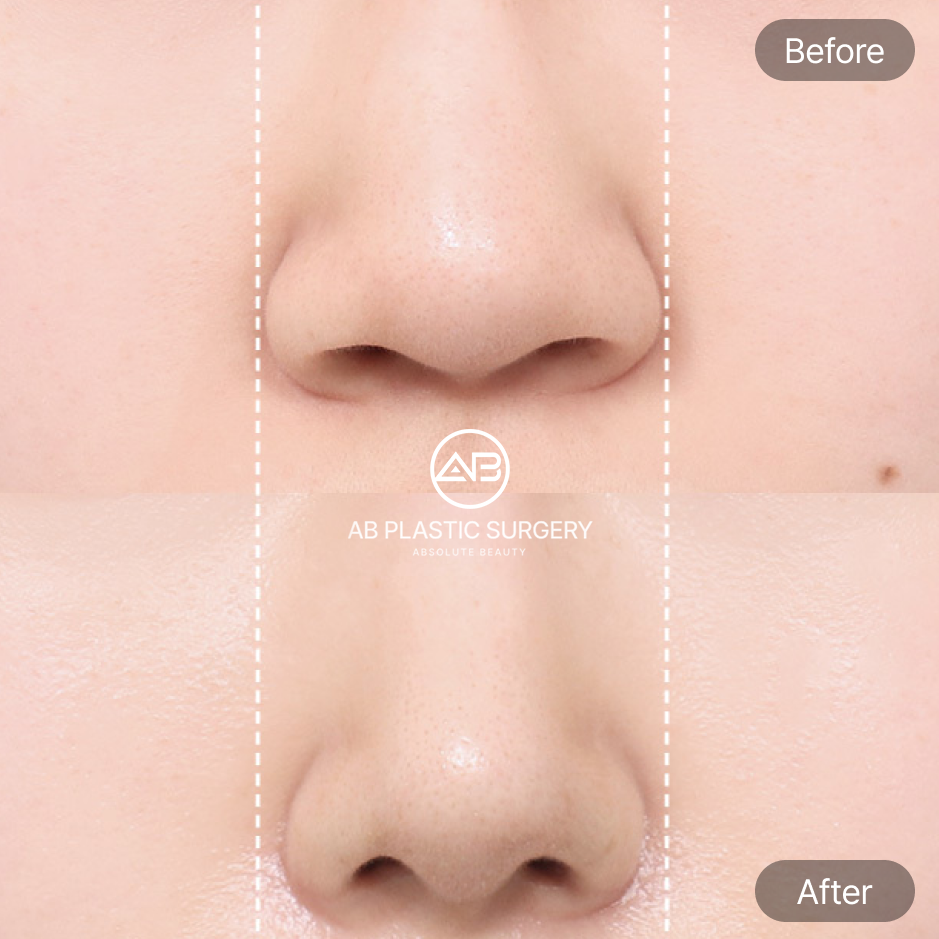 ภาพก่อน–หลังศัลยกรรมตัดปีกจมูก แสดงลักษณะจมูกที่เหมาะกับการผ่าตัด เช่น ปีกจมูกกว้าง ฐานจมูกใหญ่ และรูจมูกกว้างกว่าระยะระหว่างดวงตา