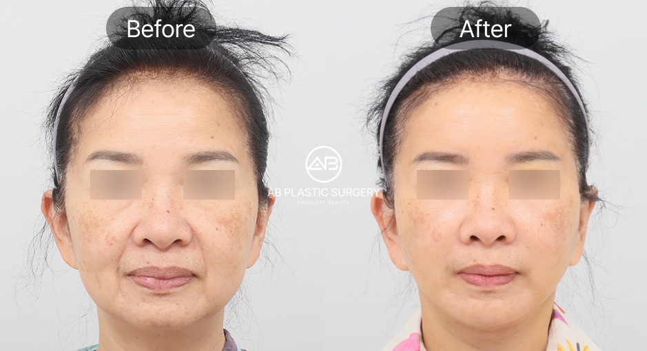 ก่อนและหลังร้อยไหมยกกระชับใบหน้าแบบเกาหลี บริเวณกรอบหน้า แก้ม และใต้คาง ผลลัพธ์ยกกระชับชัดเจน