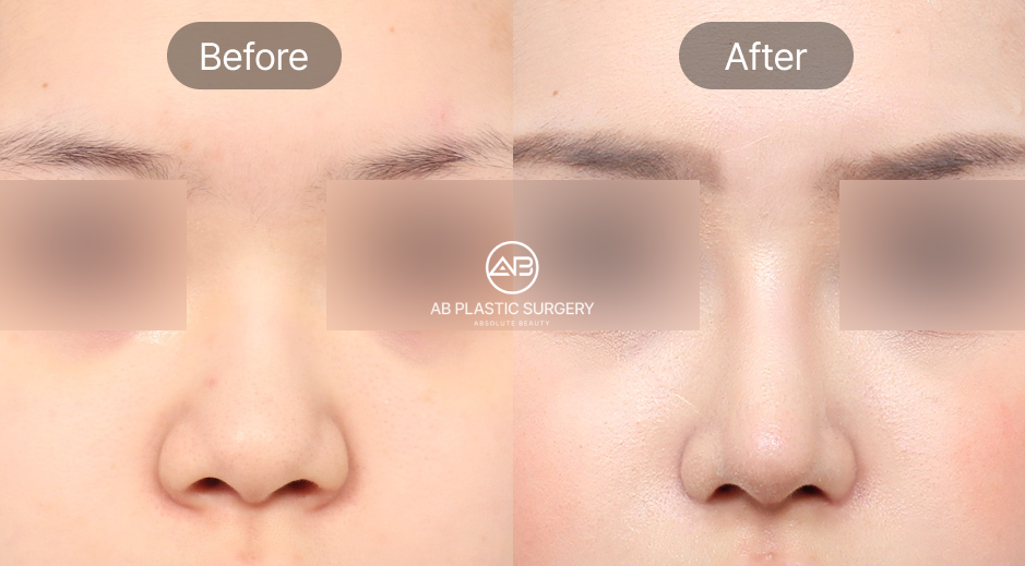 ภาพแสดงช่วงการพักฟื้นและผลลัพธ์หลังตัดปีกจมูกแบบเกาหลี โดยผู้เข้ารับบริการฟื้นตัวตามคำแนะนำของแพทย์ ทำให้แผลหายเร็วและรูปทรงจมูกเข้าที่อย่างเป็นธรรมชาติ