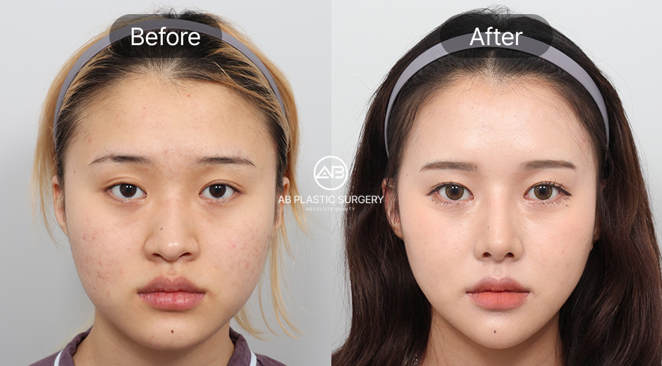 ภาพก่อนและหลังศัลยกรรมแก้คางไม่เท่ากันที่โรงพยาบาลศัลยกรรม AB ประเทศเกาหลี ปรับแนวคางให้สมดุลกับแนวแก้มและกราม ใบหน้าดูตรงขึ้นและสมมาตรอย่างเป็นธรรมชาติ
