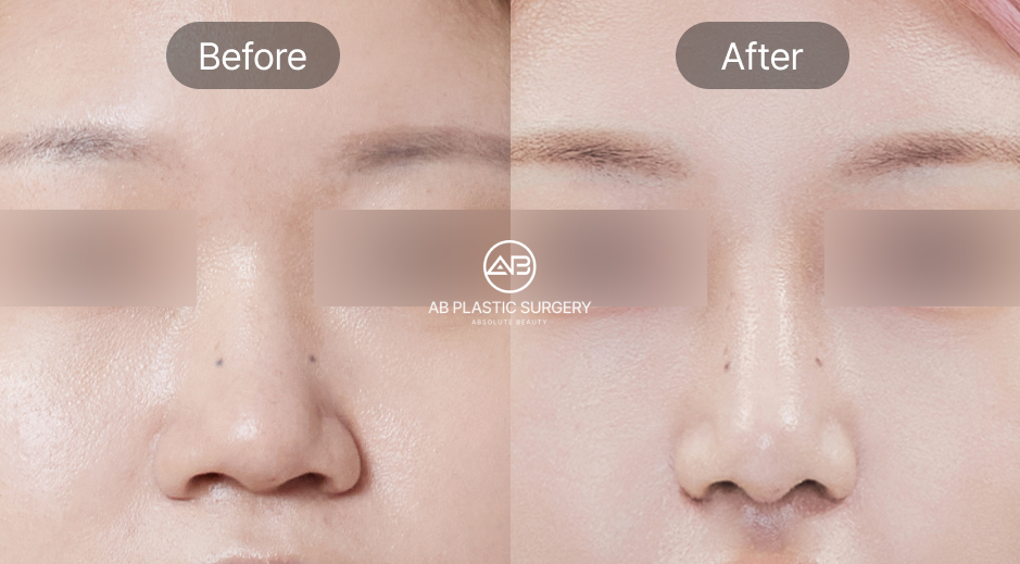 ภาพก่อน–หลังศัลยกรรมตัดปีกจมูกจริงจากโรงพยาบาลศัลยกรรม AB ประเทศเกาหลี แสดงผลลัพธ์รูจมูกที่เรียวเล็กและได้สัดส่วนอย่างเป็นธรรมชาติ