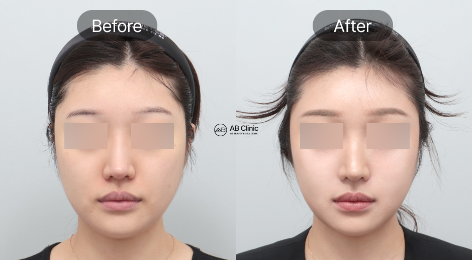ก่อนและหลังยกกระชับใบหน้าแบบเกาหลี ปรับกรอบหน้าและแก้มให้เรียวชัด เปรียบเทียบผลลัพธ์กับ HIFU และ Ulthera