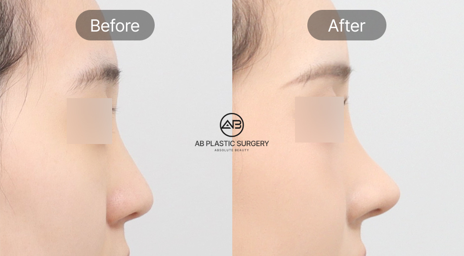 ภาพก่อนและหลังศัลยกรรมจมูกทรงหยดน้ำแบบเกาหลี ผลลัพธ์เป็นธรรมชาติ