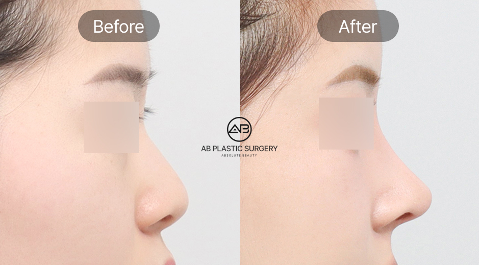 ภาพก่อนและหลังศัลยกรรมจมูกจากเคสจริง รีวิวและผลงานของโรงพยาบาลศัลยกรรม AB ประเทศเกาหลี