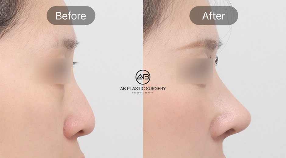 เหตุผลที่คนไทยนิยมทำศัลยกรรมจมูกที่เกาหลี ความปลอดภัยและผลลัพธ์ระยะยาว