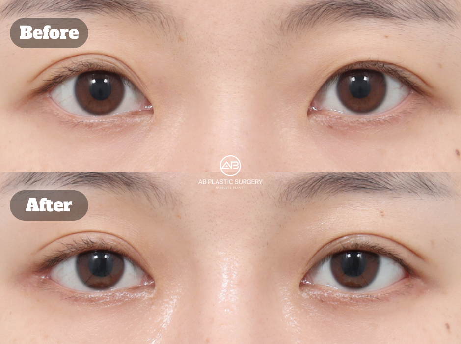 ภาพก่อนและหลังศัลยกรรมตาในเกาหลี รวมการแก้ไขรูปตาแบบไม่กรีด การเปิดหางตา การเปิดตาล่าง และการยกคิ้วด้วยเอนโดไทน์