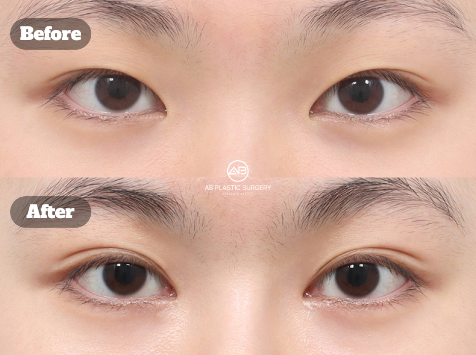 ภาพก่อนและหลังการผ่าตัดเปิดหัวตาที่ดำเนินการในประเทศเกาหลี