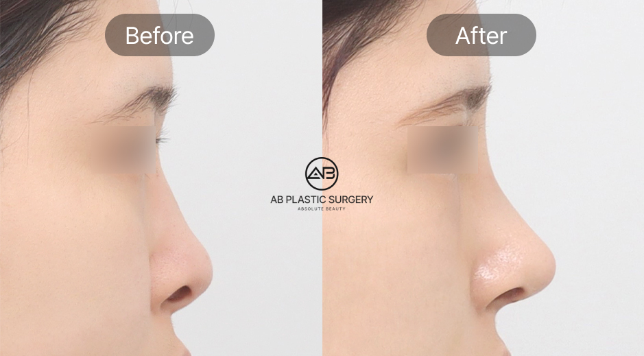 รีวิวศัลยกรรมจมูกเกาหลี ภาพก่อนและหลังจากโรงพยาบาลศัลยกรรม AB ประเทศเกาหลี