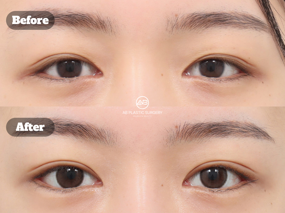 ภาพก่อนและหลังศัลยกรรมตาในเกาหลี สำหรับการผ่าตัดแก้ไขร่วมกับการเปิดหัวตาและการเปิดหางตา แสดงการเปลี่ยนแปลงของดวงตา