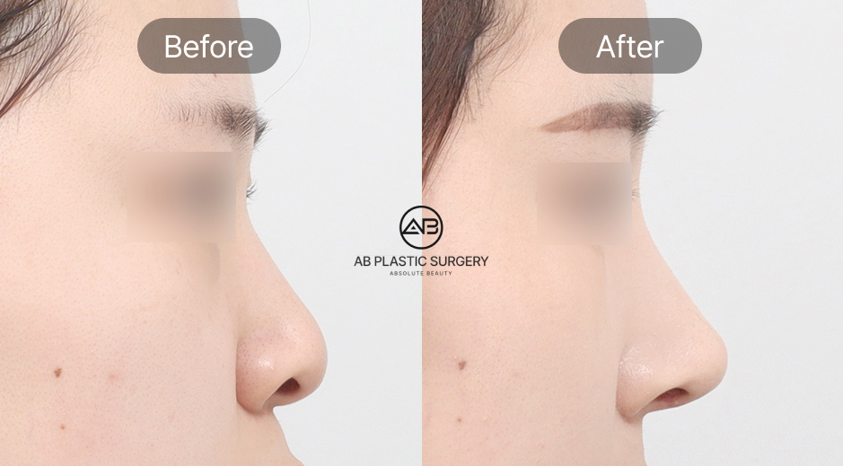 ค่าใช้จ่ายศัลยกรรมจมูกเกาหลี รายละเอียดขั้นตอนและการรักษาโดยรวม