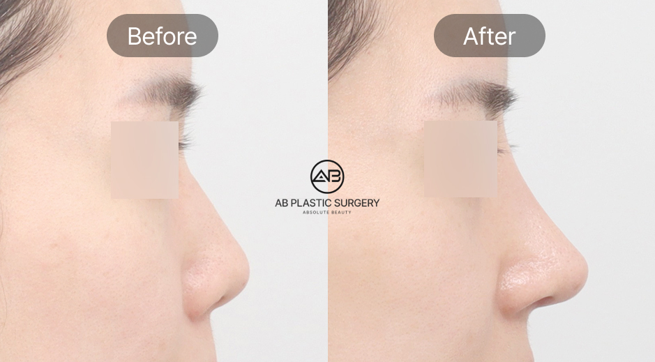 ระยะเวลาพักฟื้นหลังศัลยกรรมจมูกที่เกาหลี สำหรับผู้รับบริการจากไทย