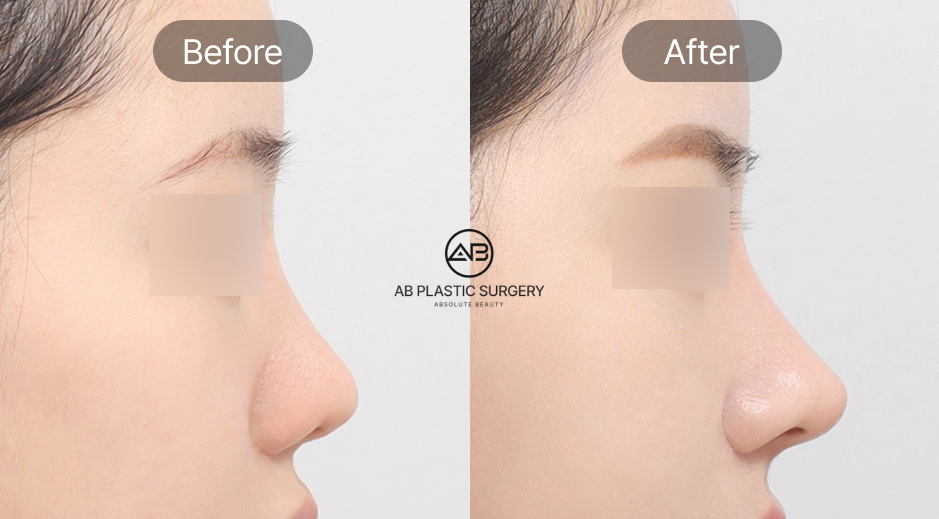 บริการล่ามภาษาไทยสำหรับศัลยกรรมจมูกที่โรงพยาบาลศัลยกรรม AB ประเทศเกาหลี