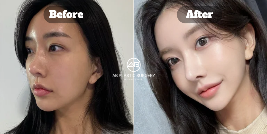 ภาพมุมด้านหน้าก่อนและหลังเสริมจมูกแบบโอเพ่นที่โรงพยาบาลศัลยกรรม AB แสดงจมูกที่ได้สัดส่วนและกลมกลืนกับใบหน้า