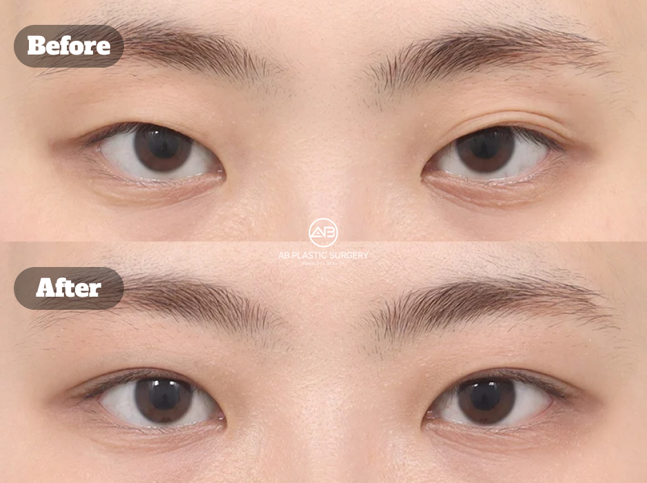 ภาพก่อนและหลังแก้กล้ามเนื้อตาแบบไม่กรีดที่เกาหลีโรงพยาบาลศัลยกรรมAB แสดงการปรับตาสองชั้นหลบในให้ดวงตาดูเปิดชัดขึ้น โดยไม่ทำการเปิดหัวตาร่วม