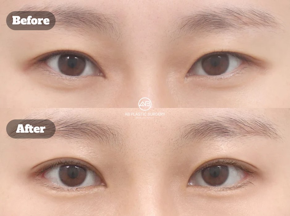 ภาพก่อนและหลังศัลยกรรมตาที่เกาหลีโรงพยาบาลศัลยกรรมAB โดยทำตาสองชั้นแบบเย็บจุดร่วมกับเปิดหางตาและเปิดหางตาล่าง เพื่อปรับตาสองชั้นหลบในและทำให้รูปตาดูยาวและเปิดกว้างขึ้นอย่างเป็นธรรมชาติ