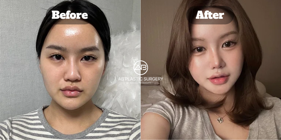 ภาพก่อนและหลังแก้จมูกฮัมพ์ด้วยเทคนิคโอเพ่นที่โรงพยาบาลศัลยกรรม AB แสดงรูปทรงจมูกที่เรียบและสมดุลขึ้น