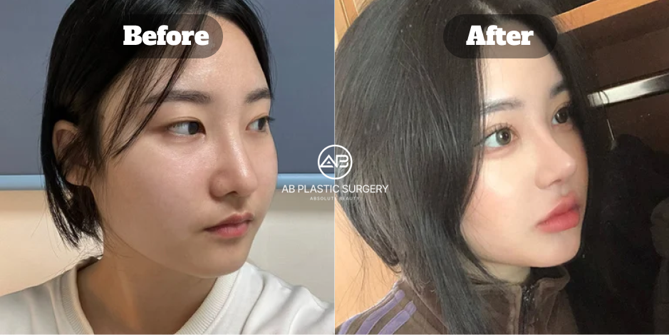 ภาพมุมด้านข้างก่อนและหลังเสริมจมูกแบบโอเพ่นที่โรงพยาบาลศัลยกรรม AB แสดงแนวสันจมูกและปลายจมูกที่ชัดเจนขึ้น