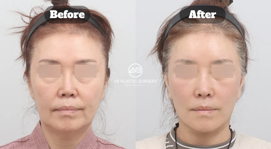ภาพเปรียบเทียบหน้าตรงของผู้ป่วยหญิงก่อนและ 1 เดือนหลังผ่าตัดดึงหน้า Full SMAS แสดงบริเวณร่องจากมุมปากลงคางและใบหน้าส่วนล่าง โดยปิดบังดวงตาและมีโลโก้ AB ตรงกลาง