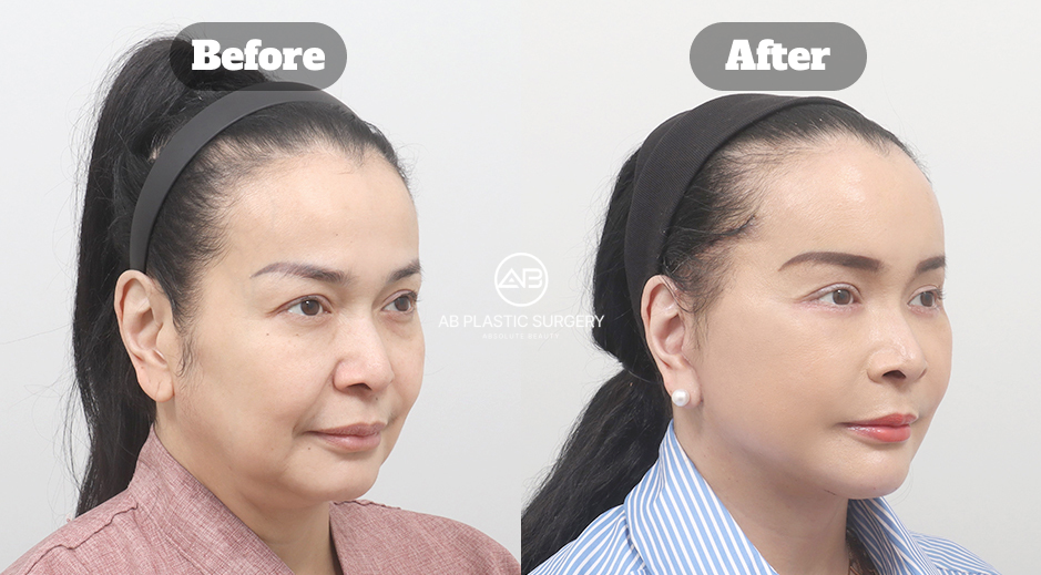 ภาพเปรียบเทียบมุมเฉียงของผู้ป่วยหญิงก่อนและหลังผ่าตัดดึงหน้า Full SMAS ดึงคอ ดูดไขมันใต้คาง และเติมไขมันใบหน้า แสดงแก้ม ใบหน้าส่วนล่าง และบริเวณมุมปาก โดยมีโลโก้ AB ตรงกลาง