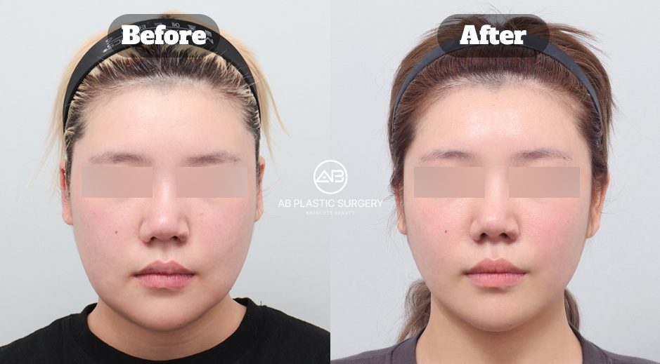ภาพใบหน้าหญิงมุมหน้าตรงสองภาพ โดยปิดบังดวงตาทั้งสองภาพ มีข้อความ Before ทางซ้ายและ After ทางขวา พร้อมโลโก้ AB ตรงกลาง