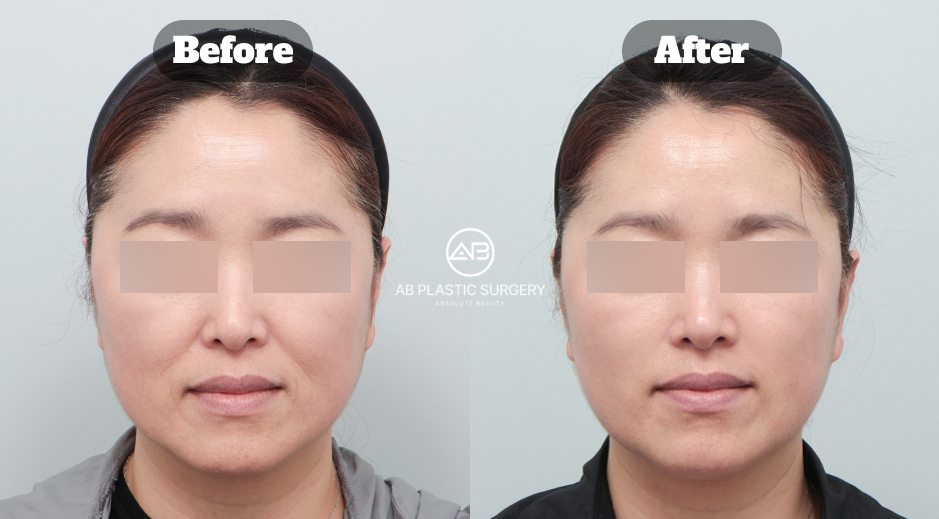 ภาพเปรียบเทียบหน้าตรงของผู้ป่วยหญิงก่อนและหลังทำอัลเทอรา ฟิลเลอร์ และชูริงก์ แสดงบริเวณร่องแก้ม มุมปาก และใบหน้าส่วนล่าง โดยปิดบังดวงตาและมีโลโก้ AB ตรงกลาง